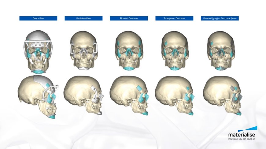 3D Technologies Support World’s First Successful Double Hand and Face Transplant